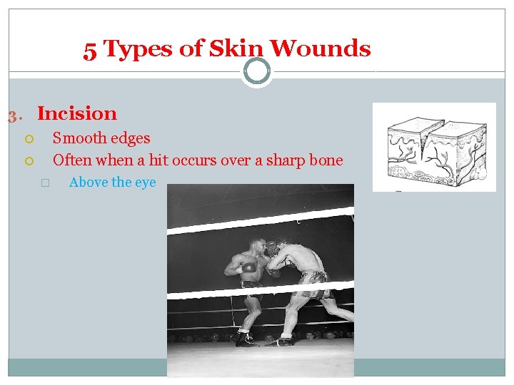 5 Types of Skin Wounds 3. Incision Smooth edges Often when a hit occurs