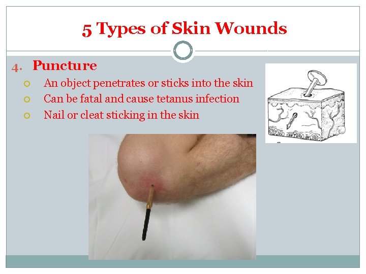 5 Types of Skin Wounds 4. Puncture An object penetrates or sticks into the