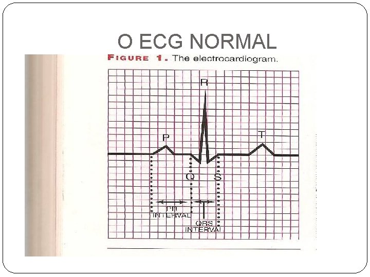 O ECG NORMAL 