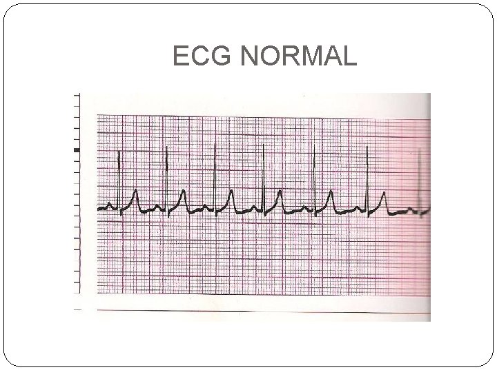 ECG NORMAL 