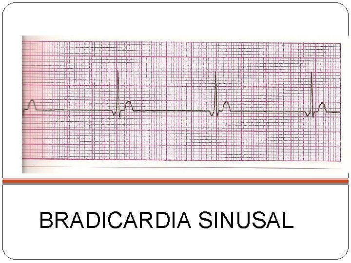 BRADICARDIA SINUSAL 