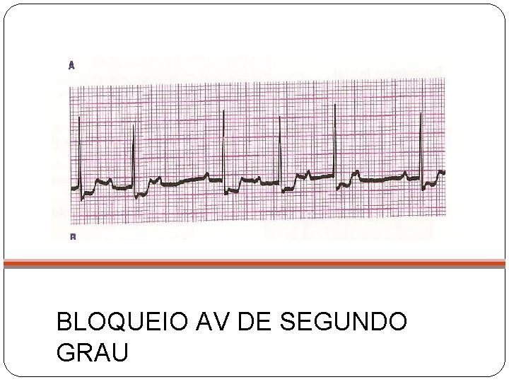 BLOQUEIO AV DE SEGUNDO GRAU 