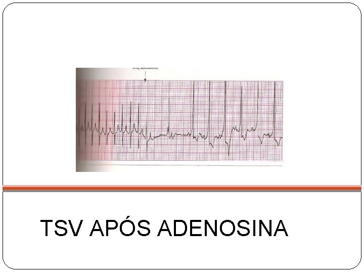 TSV APÓS ADENOSINA 
