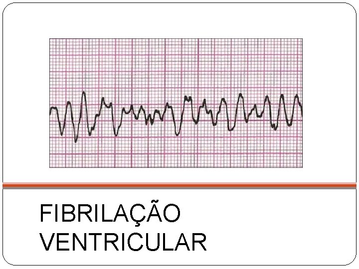 FIBRILAÇÃO VENTRICULAR 