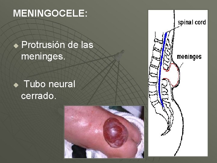 MENINGOCELE: u u Protrusión de las meninges. Tubo neural cerrado. 