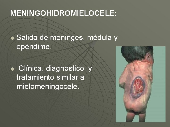 MENINGOHIDROMIELOCELE: u u Salida de meninges, médula y epéndimo. Clínica, diagnostico y tratamiento similar