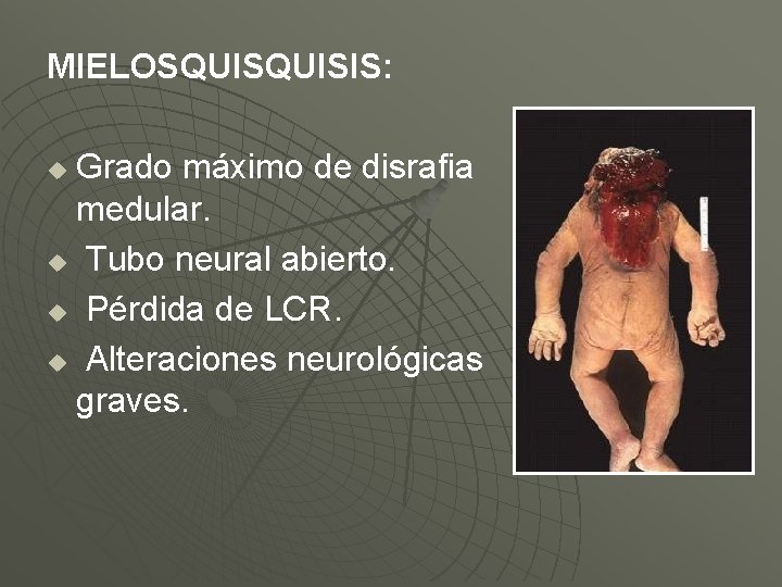 MIELOSQUISIS: Grado máximo de disrafia medular. u Tubo neural abierto. u Pérdida de LCR.