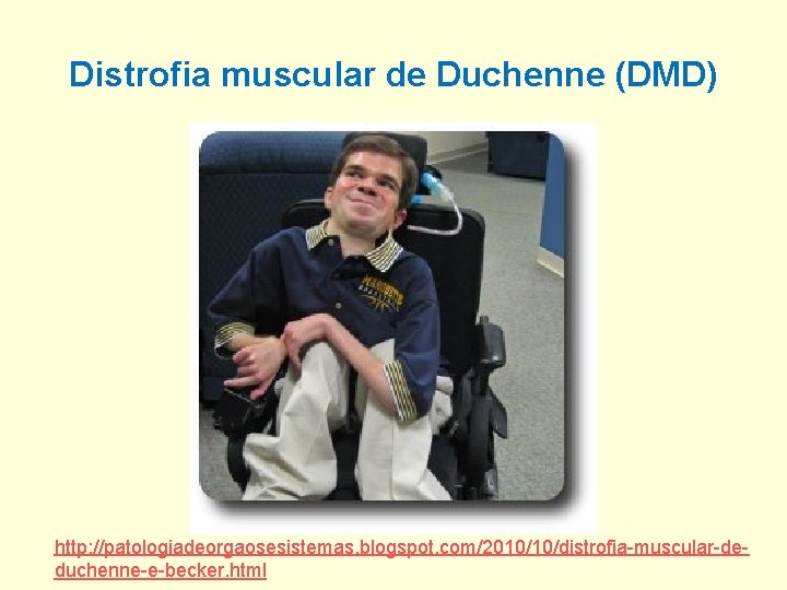 Distrofia muscular de Duchenne (DMD) http: //patologiadeorgaosesistemas. blogspot. com/2010/10/distrofia-muscular-deduchenne-e-becker. html 