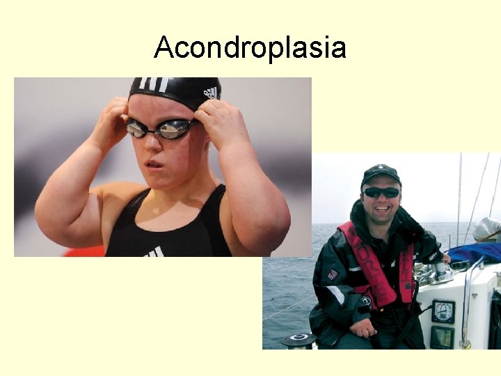 Acondroplasia 