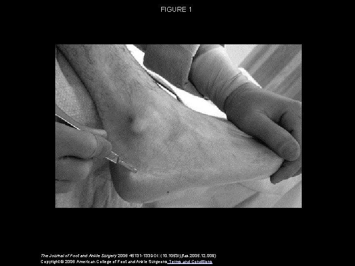 FIGURE 1 The Journal of Foot and Ankle Surgery 2006 45131 -133 DOI: (10.