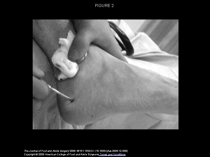 FIGURE 2 The Journal of Foot and Ankle Surgery 2006 45131 -133 DOI: (10.