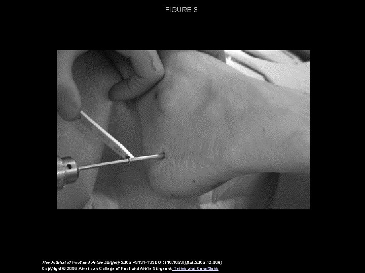 FIGURE 3 The Journal of Foot and Ankle Surgery 2006 45131 -133 DOI: (10.