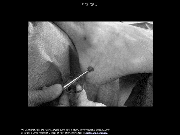 FIGURE 4 The Journal of Foot and Ankle Surgery 2006 45131 -133 DOI: (10.