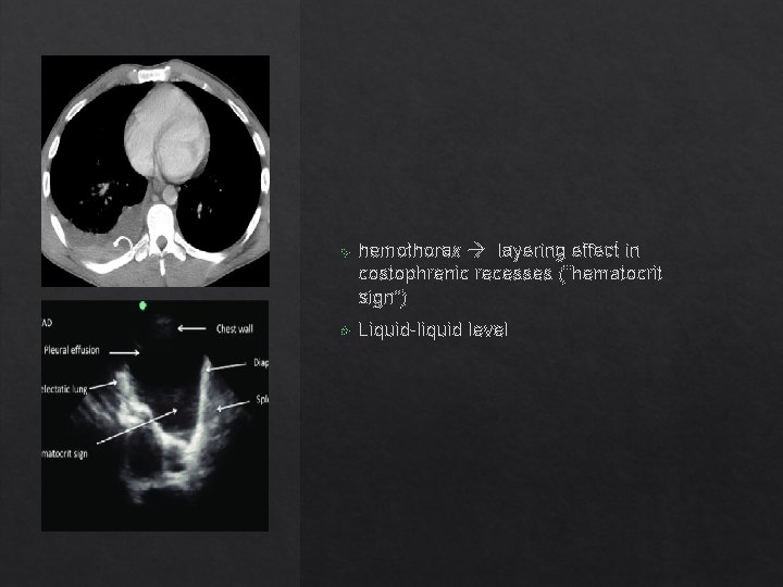  hemothorax layering effect in costophrenic recesses (“hematocrit sign”) Liquid-liquid level 