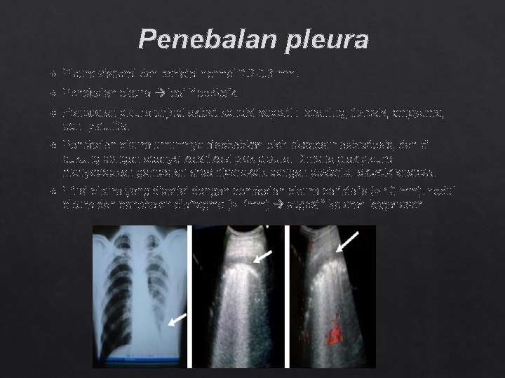 Penebalan pleura Pleura visceral dan parietal normal 0, 2 -0, 3 mm. Penebalan pleura