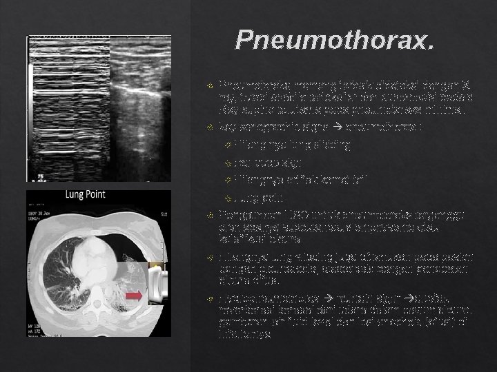 Pneumothorax. Pneumotoraks memang terbaik dideteksi dengan X ray, tetapi apabila terlokalisr dan superposisi pada