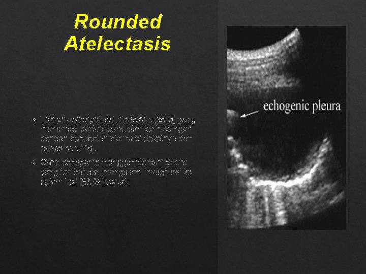 Rounded Atelectasis Tampak sebagai lesi hipoekoik (solid) yang menempel pada pleura, dan berhubungan dengan