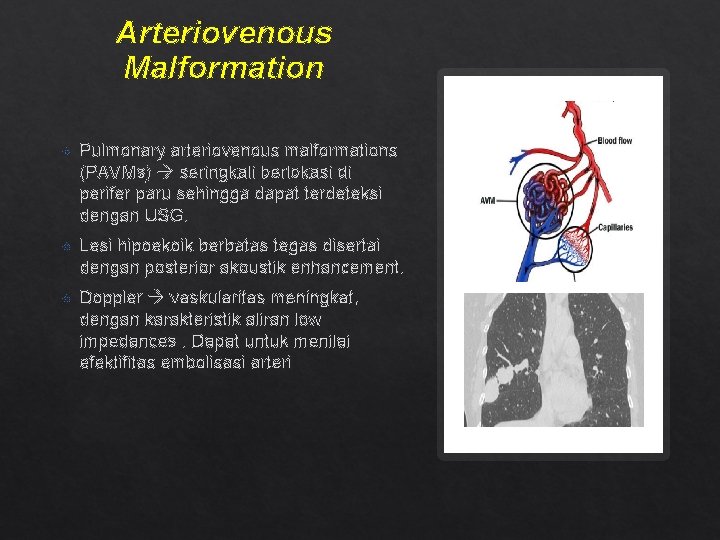 Arteriovenous Malformation Pulmonary arteriovenous malformations (PAVMs) seringkali berlokasi di perifer paru sehingga dapat terdeteksi