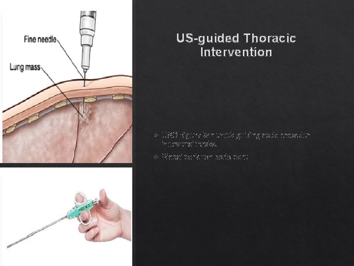 US-guided Thoracic Intervention USG digunakan untuk guiding pada prosedur intervensi toraks. Biopsi perkutan pada