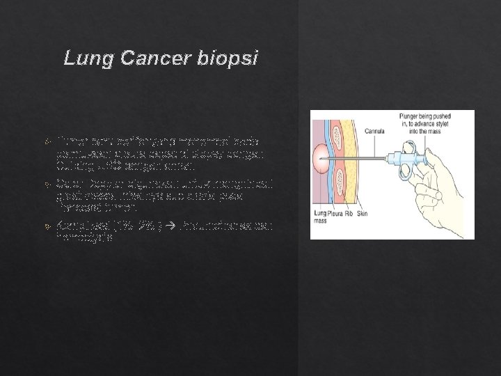 Lung Cancer biopsi Tumor paru perifer yang menempel pada permukaan pleura dapat di biopsy