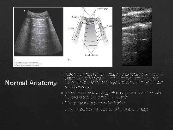  Anatomi normal dinding dada tampak sebagai lapisan soft tissue ekogenik yang menunjukkan gambaran