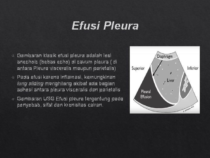 Efusi Pleura Gambaran klasik efusi pleura adalah lesi anechoic (bebas echo) di cavum pleura