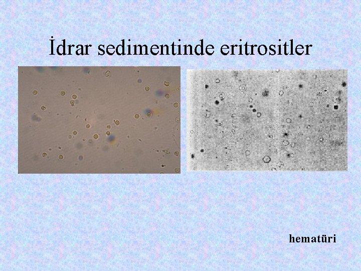 İdrar sedimentinde eritrositler hematüri 