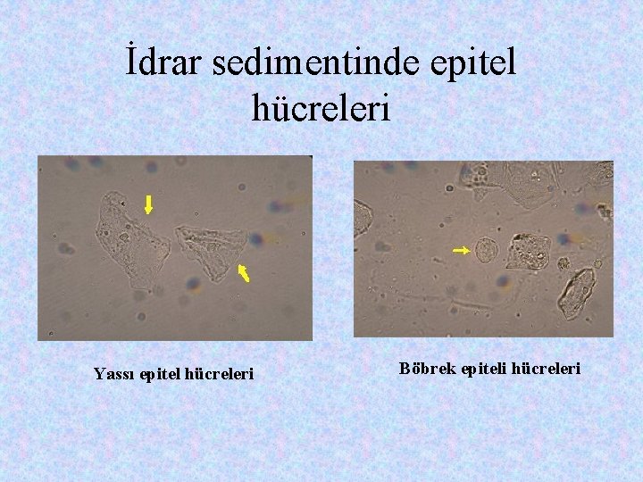 İdrar sedimentinde epitel hücreleri Yassı epitel hücreleri Böbrek epiteli hücreleri 