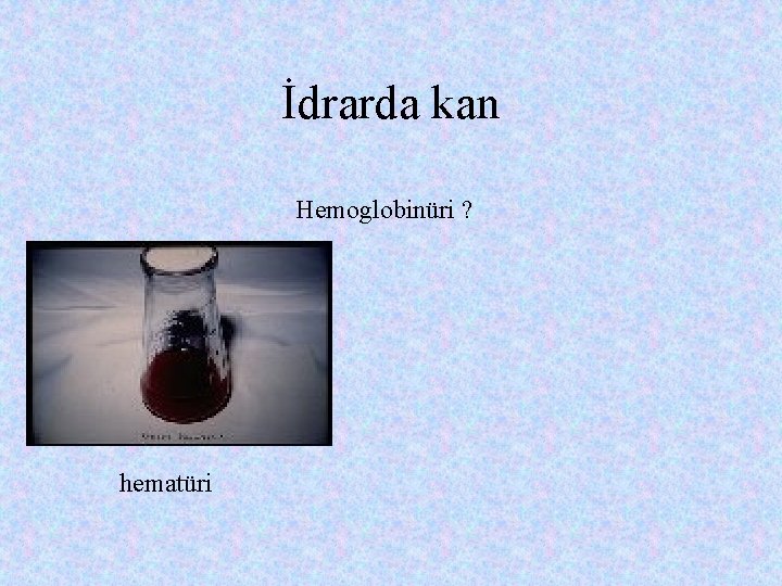 İdrarda kan Hemoglobinüri ? hematüri 