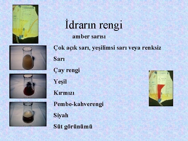 İdrarın rengi amber sarısı Çok açık sarı, yeşilimsi sarı veya renksiz Sarı Çay rengi