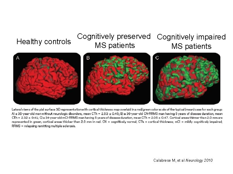 Cognitively preserved Cognitively impaired Healthy controls MS patients Calabrese M, et al Neurology 2010
