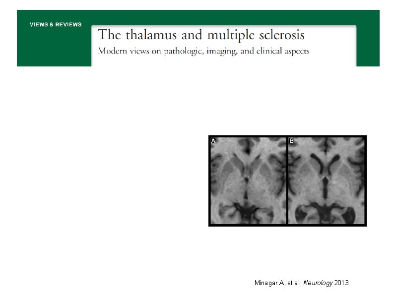 Minagar A, et al. Neurology 2013 