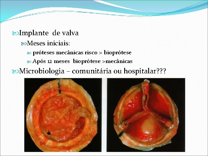 Implante de valva Meses iniciais: próteses mecânicas risco > bioprótese Após 12 meses