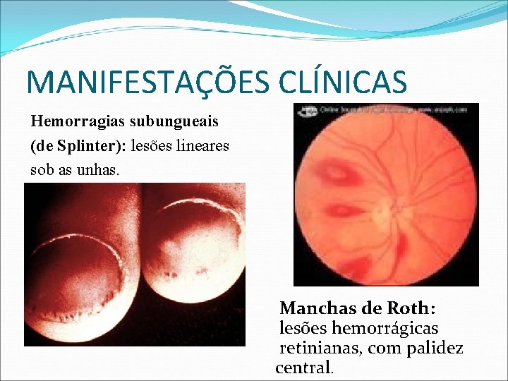 MANIFESTAÇÕES CLÍNICAS Hemorragias subungueais (de Splinter): lesões lineares sob as unhas. Manchas de Roth: