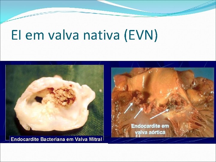 EI em valva nativa (EVN) 