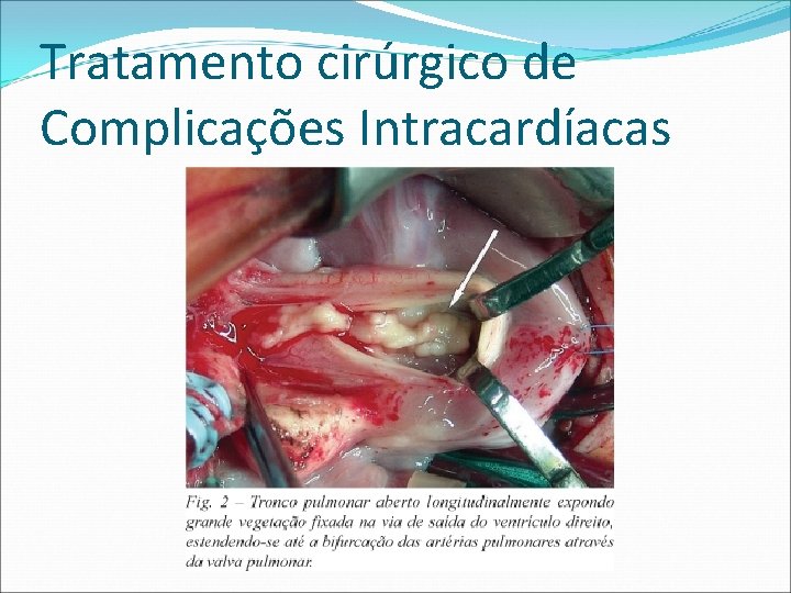 Tratamento cirúrgico de Complicações Intracardíacas 