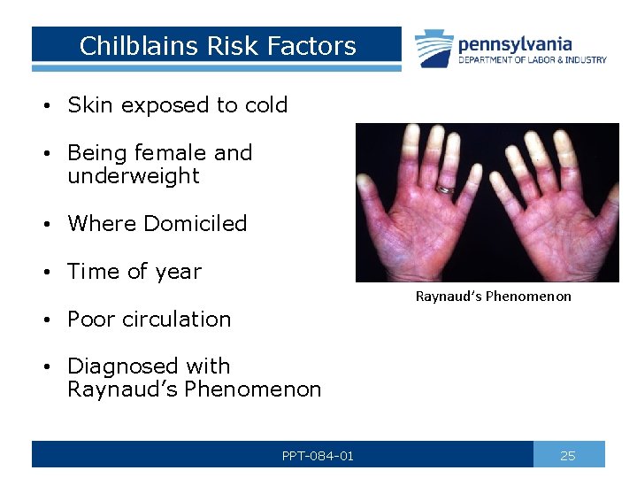 Chilblains Risk Factors • Skin exposed to cold • Being female and underweight •