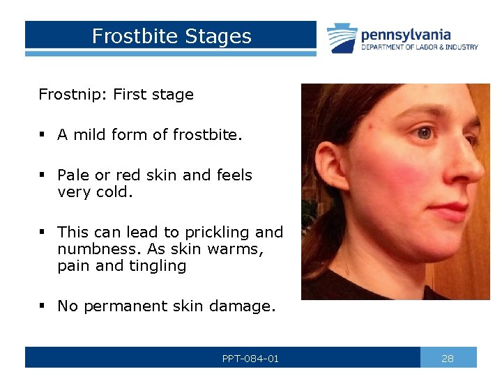 Frostbite Stages Frostnip: First stage § A mild form of frostbite. § Pale or