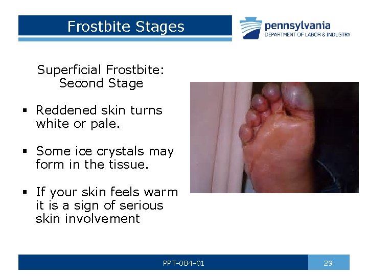Frostbite Stages Superficial Frostbite: Second Stage § Reddened skin turns white or pale. §
