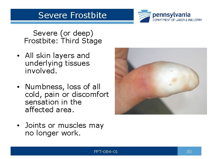 Severe Frostbite Severe (or deep) Frostbite: Third Stage • All skin layers and underlying
