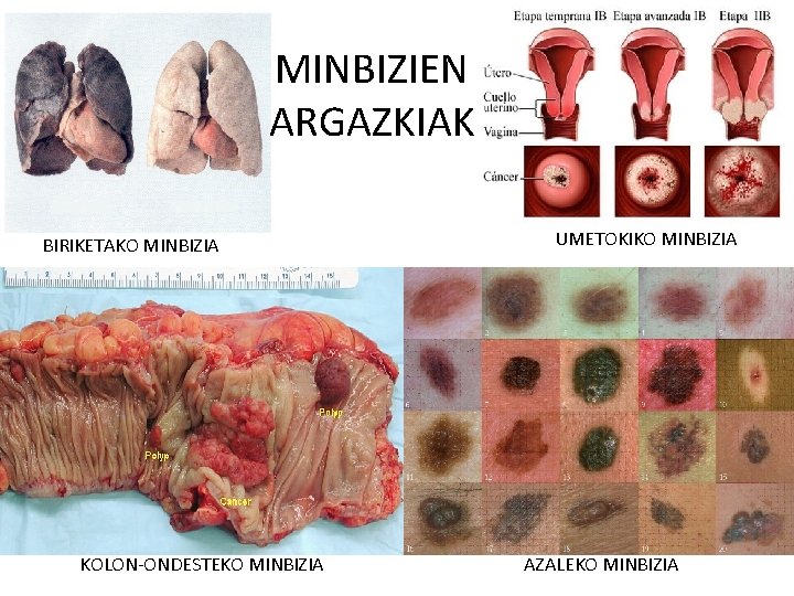 MINBIZIEN ARGAZKIAK BIRIKETAKO MINBIZIA KOLON-ONDESTEKO MINBIZIA UMETOKIKO MINBIZIA AZALEKO MINBIZIA 