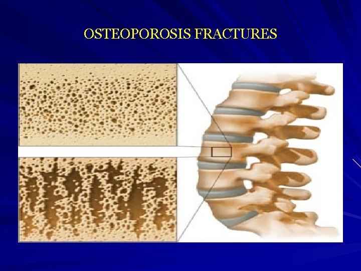 OSTEOPOROSIS FRACTURES 