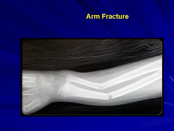 Arm Fracture 