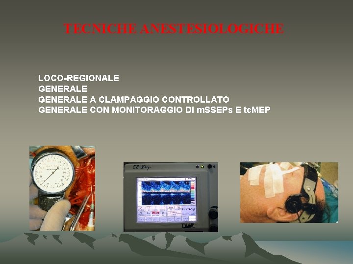 TECNICHE ANESTESIOLOGICHE LOCO-REGIONALE GENERALE A CLAMPAGGIO CONTROLLATO GENERALE CON MONITORAGGIO DI m. SSEPs E