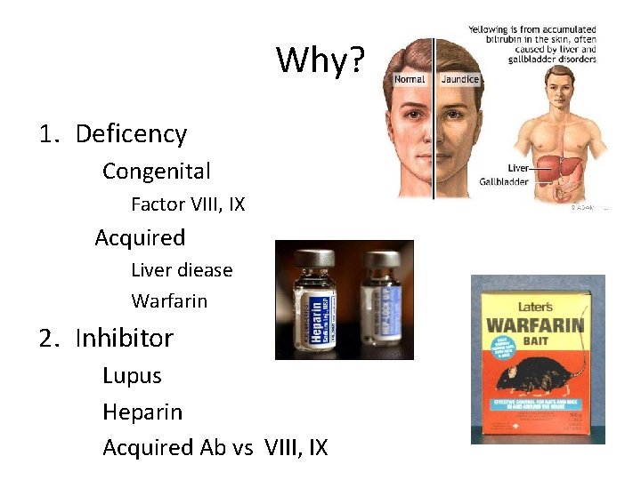 Why? 1. Deficency Congenital Factor VIII, IX Acquired Liver diease Warfarin 2. Inhibitor Lupus
