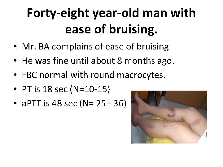 Forty-eight year-old man with ease of bruising. • • • Mr. BA complains of