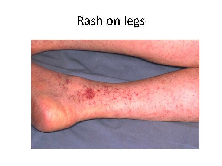 Rash on legs 