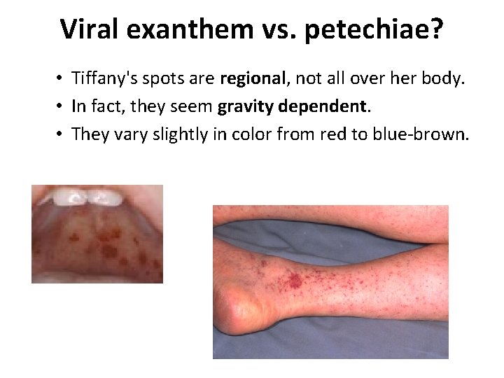 Viral exanthem vs. petechiae? • Tiffany's spots are regional, not all over her body.