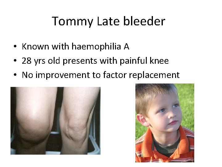 Tommy Late bleeder • Known with haemophilia A • 28 yrs old presents with