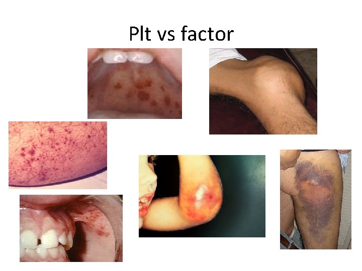 Plt vs factor 